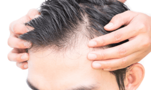 تعليمات بعد عملية زراعة الشعر 