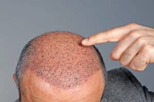 تعليمات بعد عملية زراعة الشعر 