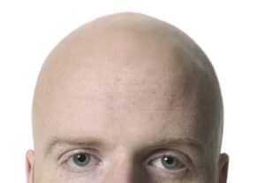 تعليمات قبل عملية زراعة الشعر